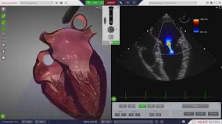 HeartWorks Mitral Regurgitation [upl. by Jacobba646]