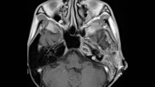 Petrous Apex Abscess [upl. by Ahsienor534]