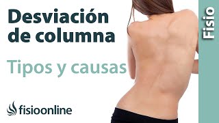 Escoliosis o desviación lateral de columna  Qué es causas tipos [upl. by Klusek]