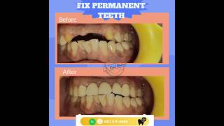 Permanent fix teeth nashik teeth pfm zirconia [upl. by Madalyn788]