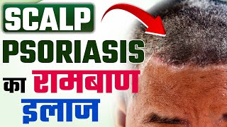 Scalp psoriasis removal  psoriasis scalp removal  home remedies for scalp psoriasis [upl. by Herbert]