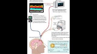 Cerebral microdialysis and brain tissue oxygenation  Dr Shruti Agrawal and Mr Ibrahim Jalloh [upl. by Ifen]