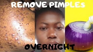 How To Remove Pimples Overnight  Acne Treatment  With Onions [upl. by Havot]