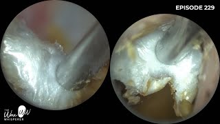 229  This patient attended with a suspected benign osteonecrosis and otomycosis [upl. by Wendie151]