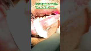 Exfoliatve cheilitis treated by Laser [upl. by Enylhsa]