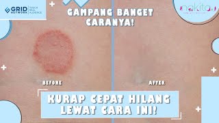 Catat Ini Cara Menghilangkan Kurap Secara Alami [upl. by Adriana]