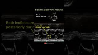 BiLeaflet Mitral Valve Prolapse echocardiography cardiology [upl. by Eedolem]