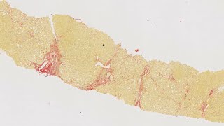 HISTALIM Chronic diseases  Hepatic fibrosis collagen quantification on human liver [upl. by Conall415]