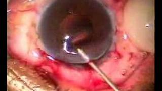 Intracapsular cryo extraction and Artisan Lens implant [upl. by Kilmarx778]