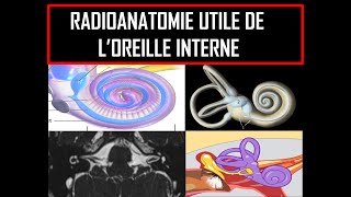 Radioanatomie utile de loreille interne [upl. by Adnilasor338]