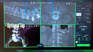 Robotic spinal fusion globot [upl. by Wentworth]