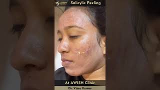 Peeling Treatment  Salicylic peel for pigmentation and acne peeling shorts awishclinic [upl. by Japha]