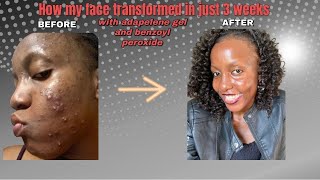 How my skin transformed in just 3 weeks of using adapalene gel and Benzoyl peroxide [upl. by Nani]