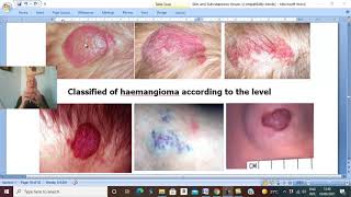 Skin and subcutaneous tissues in Arabic 8 Haemangioma  by Dr Wahdan [upl. by Neirbo977]