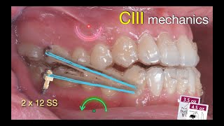 Solving anterior Crossbite with Aligners｜【Chris Chang Ortho】CC808 [upl. by Marquez]