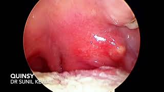 Quinsy  Peritonsillar Abscess  Dr Sunil Kewat [upl. by Inaja]