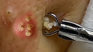 Big Cystic Acne Blackheads Extraction Blackheads amp Milia Whiteheads Removal Pimple Popping 070 [upl. by Names]