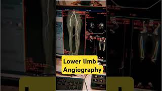 Lower limb angio VRT images vrt angiogram 3d ctangiography ctscan angiography anatomy [upl. by Enalb645]