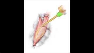 BioGlues Role as a Surgical Sealant in Vascular Surgery [upl. by Asital822]