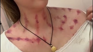 kerokanguasha kerokan cupping massage [upl. by Fai546]