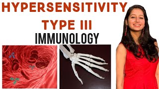 Hypersensitivity Type IIISimplified ExplanationImmunologyImmune ComplexAntigen Antibody [upl. by Aseena748]