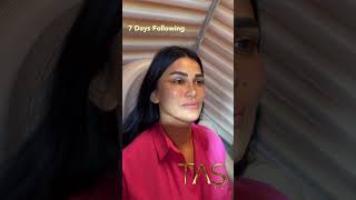 Face Neck Temporal amp Forehead Lift Fat Grafting Laser Skin Tightening by Dr Suleyman TAS [upl. by Inoliel49]