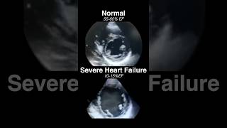 Echocardiogram NORMAL vs SEVERE HEART FAILURE radiology cardiology [upl. by Ahseket]