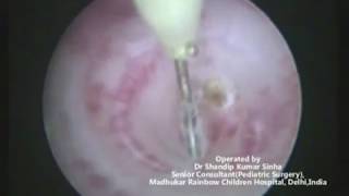 PUV fulguration by different means hookloop and bugbee by Dr shandip sinhaped urologist [upl. by Yht759]