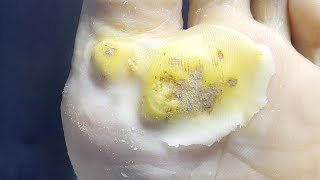 Plantar wart treatment Continuous pedicures required [upl. by Samid]