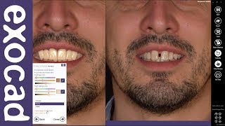 exocad Quick Guide Learn Smile Creator in 7 min [upl. by Faxan]