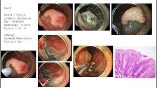 ESD and EMR of Lesion of GI Tract  Todua Clinic [upl. by Bodwell898]