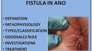 FISTULA IN ANO HINDI [upl. by Imuy]