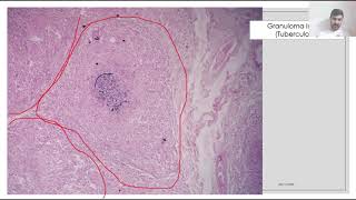 Aula prática sobre inflamação crônica e crônica granulomatosa [upl. by Nylrats]