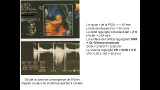 CARDIOLOGIE INSUFFISANCE MITRALE [upl. by Notyad]