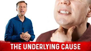 Burning Throat Syndrome or Silent Acid Reflux Causes – DrBerg [upl. by Enyledam776]