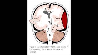 Herniation Syndromes  Cingulate subfalcine Transtentorial Uncal amp Cerebellar Tonsillar [upl. by Rochelle]