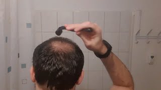 Minoxidil  Derma Roller Results I 4 Months Update [upl. by Lasko]