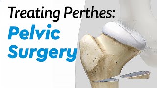 Pelvic Surgery for Treating Perthes Disease in Children [upl. by Ansell706]