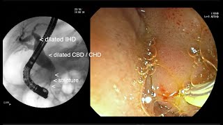 ERCP PANCREATIC PSEUDOCYST AFTER HAEMOLYTIC URAEMIC SYNDROME [upl. by Mclaughlin97]