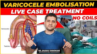 Live Varicocele embolisation case 2  Without any metal coils  Dr Gaurav Gangwani IR [upl. by Alliuqaj]