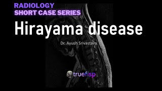 Hirayama disease Radiology  Dr Ayush Srivastava  Short case  ft Radiology Counsellors [upl. by Nwahsyt]