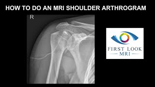 How to do an MRI shoulder arthrogram [upl. by Nnalatsyrc]