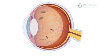 Floaters and Posterior Vitreous Detachment PVD [upl. by Fraase]