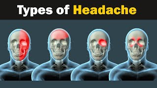 Headache  Types and causes  3d Animation [upl. by Artina]