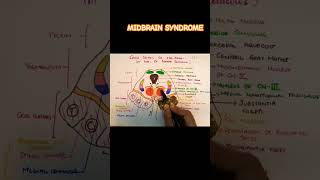 webersyndrome clinicalneuroanatomy midbrain [upl. by Rind319]