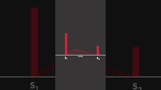 Aortic Stenosis [upl. by Farrish]