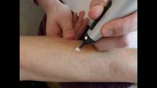 Treatment of a pigmentation spot with cryotherapy  Cryopen [upl. by Evadne]