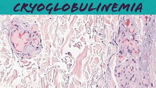 Cryoglobulinemia type 1 pathology USMLE dermpath dermatology [upl. by Lorin]