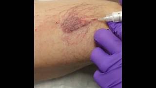 Sclerotherapy for Varicose amp Spider Veins at DermMedica [upl. by Favian]