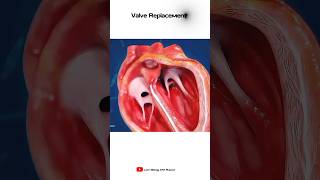 Heart Valve Replacement  Short animation [upl. by Di]